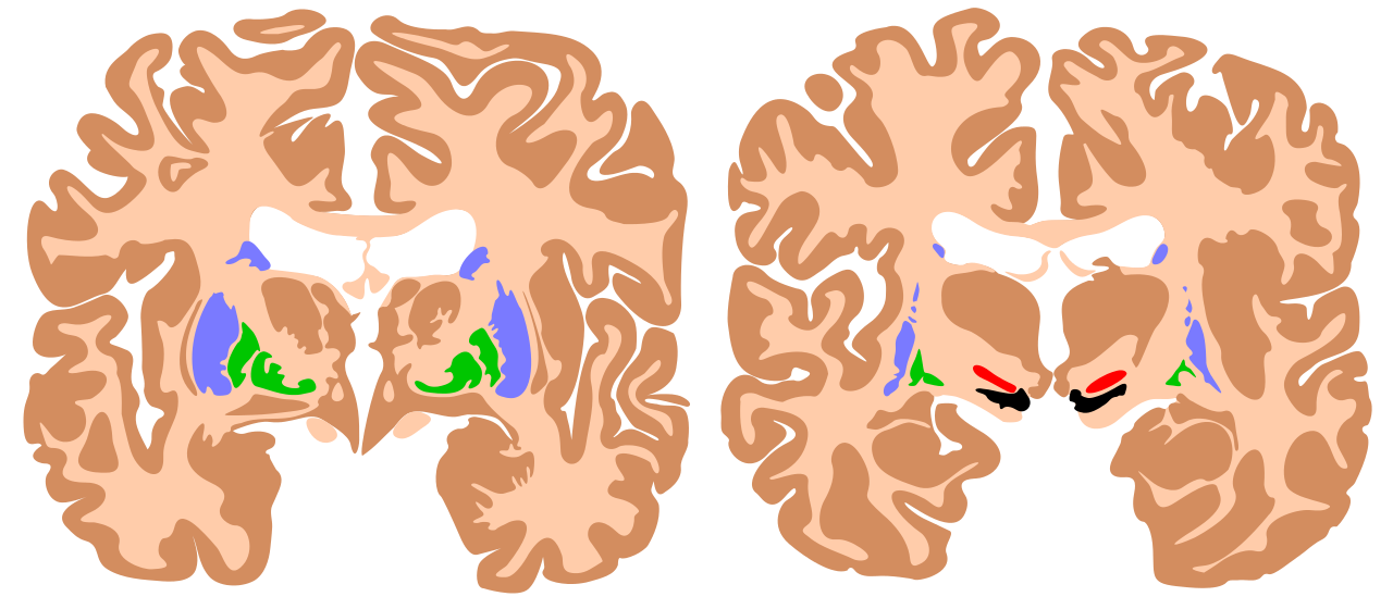 Síntomatología del lóbulo frontal